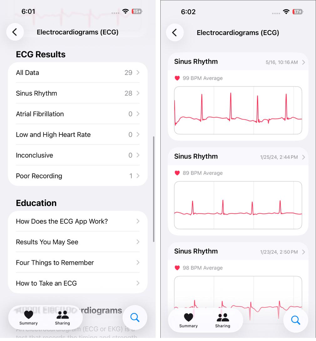 Understanding Apple Watch ECG Results and What They Mean